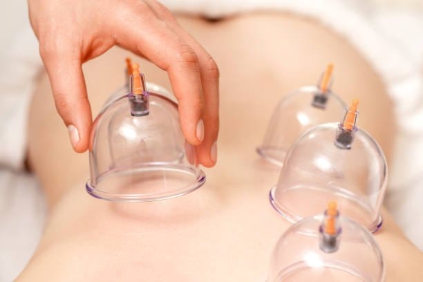 Cupping therapy Vacuum cups of medical cupping therapy on woman back, close up, chinese medicine, therapeutic massage