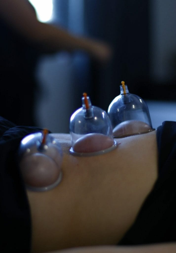 CUPPING TREATMENT, BACK PAIN, TREATMENT AIRDRIE, ATHLETIC THERAPIST, MASSAGE THERAPY, Revival airdrie, revival therapeutics and performance, therapeutic massage airdrie